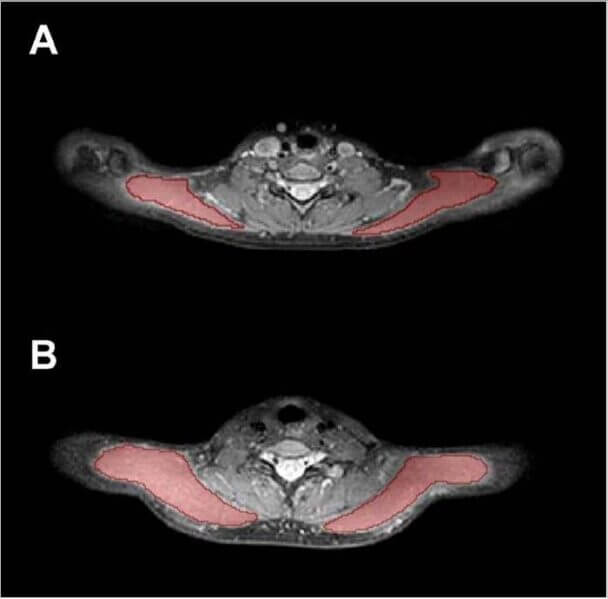 Exemplary cases for trapezius muscle segmentations. (A) Segmentation masks of the bilateral trapezius muscles (red areas) in a 25-year-old female and (B) in a 24-year-old male.