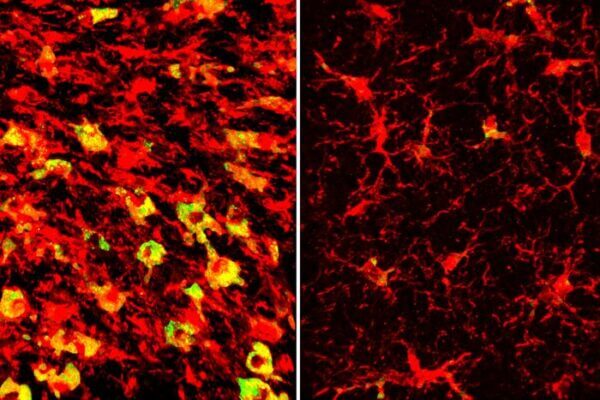 Lowering a form of brain cholesterol cuts Alzheimer’s-like damage in mice