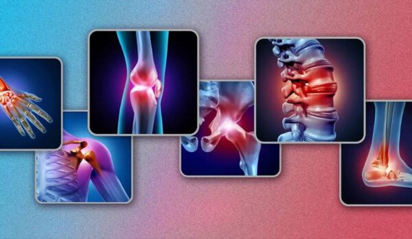 Epilepsy drug shows promise in slowing joint degeneration in osteoarthritis