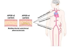 Individuals who carry the APOE4 gene variant have an elevated riskof developing subclinical atherosclerosis in middle age, whereas carriers of the variant APOE2 are protected.