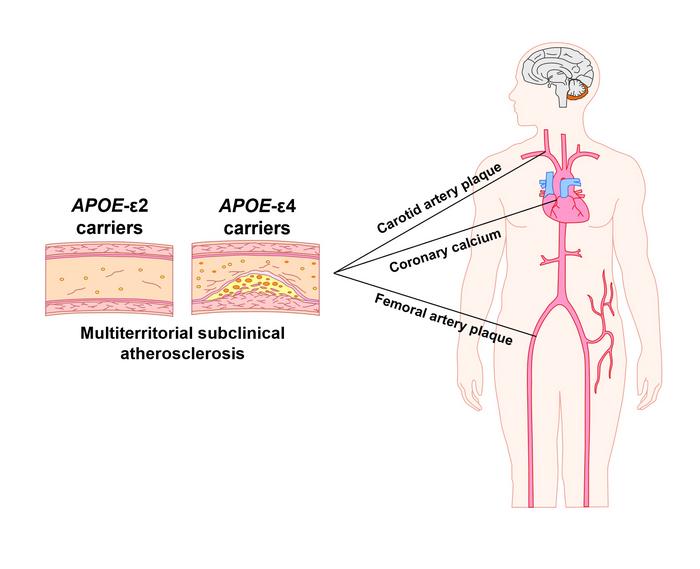 Individuals who carry the APOE4 gene variant have an elevated riskof developing subclinical atherosclerosis in middle age, whereas carriers of the variant APOE2 are protected.