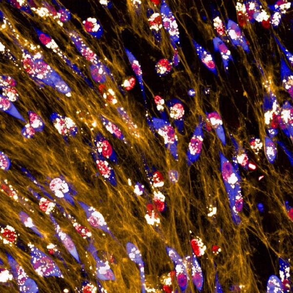 Breast cancer cells (in blue) eating extracellular matrix (yellow). The bright white spots inside the cells are extracellular matrix components that are being digested by the cells, for them to obtain nutrients to support their growth.