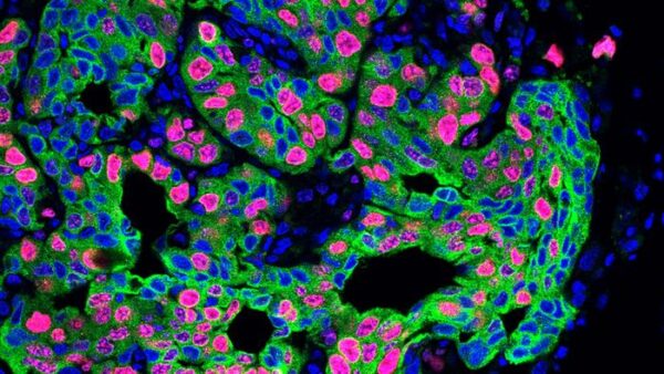  lung cancer metastasis in a m...                    </div>

                    <div class=