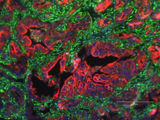 Researchers identify protein linked to metastasis in pancreatic cancer