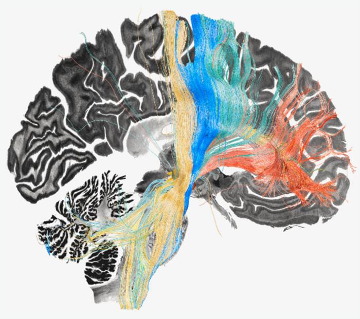 Fiber bundles associated with symptom improvement following deep brain stimulation in Parkinson’s disease (green), dystonia (yellow), Tourette’s syndrome (blue),and obsessive-compulsive disorder (red). Courtesy of Barbara Hollunder.