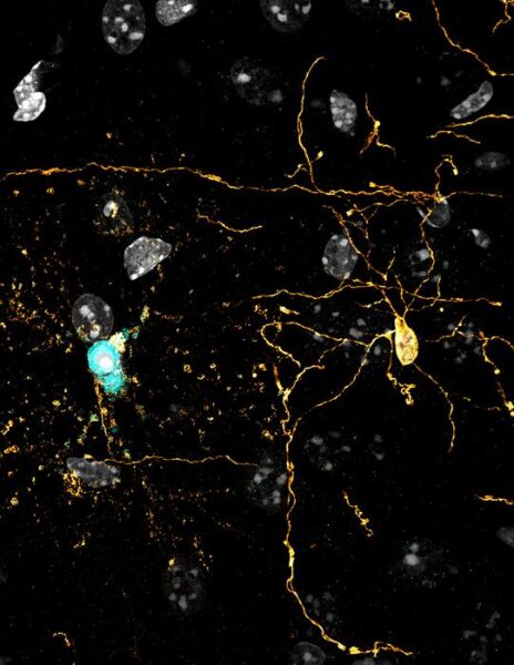 A living-tissue model developed by Dartmouth researchers showed that a fatal trauma killed younger oligodendrocytes (blue) within 24 hours, while mature cells (yellow) took 45 days to die.