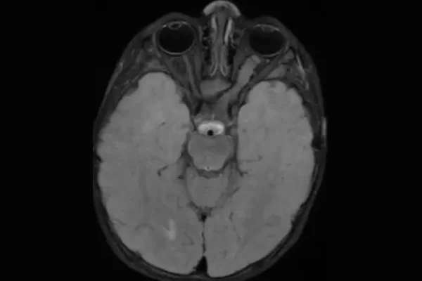 A brain scan of a neurofibromatosis type 1 (NF1) patient reveals a tumor on the optic nerve connecting the left eye to the brain (right side of the image). Researchers at Washington University School of Medicine in St. Louis have discovered that an FDA-approved epilepsy drug can prevent or slow the growth of NF1-linked optic gliomas in mice, laying the groundwork for a clinical trial.
