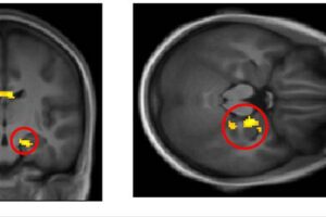 MRI visualisation of hippocampal activation. Photo: UNIGE