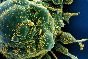 Colorized scanning electron micrograph of an apoptotic cell (green) heavily infected with SARS-COV-2 virus particles (yellow), isolated from a patient sample. (Image credit: NIAID)