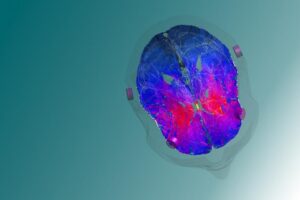 A model image of the targeted deep brain zone, the striatum, which plays a crucial role in reward and reinforcement mechanisms.