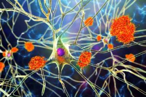 Protein clump amid neurons