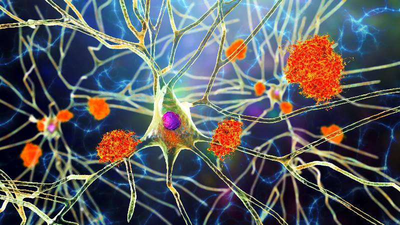 Protein clump amid neurons