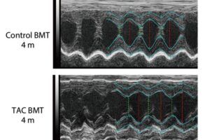 Transplantation of bone marrow from mice with heart failure (TAC, meaning transverse aortic constriction) into healthy mice (control) led to cardiac dysfunction, as shown in this echocardiogram. The light blue lines represent the motion of the anterior and posterior walls of the heart. In the upper diagram, the movement is vigorous and healthy. By contrast, in the lower diagram, the movement is impaired, and the distance between the walls is widened. This is characteristic of heart failure, where the heart's movement deteriorates and the heart enlarges.