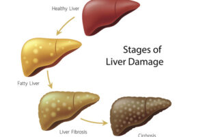 Liver infographic showing stages leading from healthy to cirrhosis