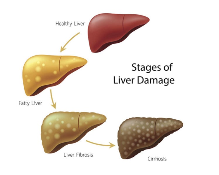 Liver infographic showing stages leading from healthy to cirrhosis