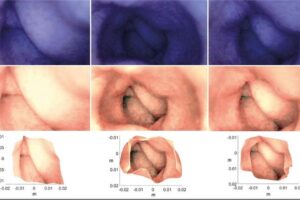 Three original images from an artificial colon, taken using an endoscope. The 3D model can be used to adjust the lighting in an original image so that darker areas become better illuminated, as shown in the images below. Bottom: The reconstructed 3D model based on the three originals.