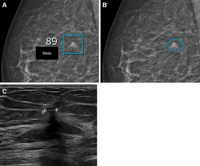 Breast scan