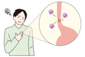 Eosinophilic esophagitis is a condition where white blood cells called eosinophils accumulate in the esophagus, leading to difficulty swallowing.