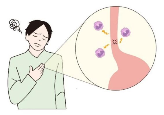 Eosinophilic esophagitis is a condition where white blood cells called eosinop...                    </div>

                    <div class=