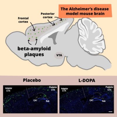 Dopamine Shows Promise in Reducing Alzheimer’s Symptoms