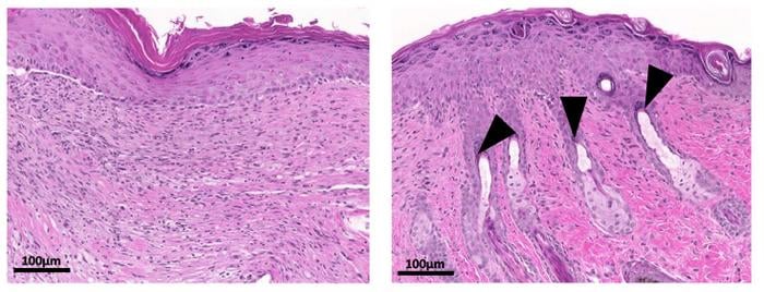 12 days after wounding, untreated skin (left) lacks hair follicles, but TGM treatment (right) promotes the formation of new hair follicles (arrowheads) as the tissue heals and regenerates.