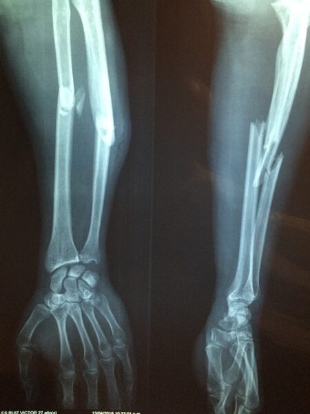 xray of broken arm