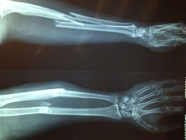 xray of broken arm