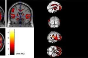 This case highlights the effectiveness of using multimodality approaches for diagnosing iNPH, which not only saves the patient time but also reduces clinical costs. This approach is worth further promotion.