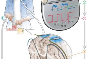 Implanted device responds to changes in brain signals, adjusting the amount of stimulation throughout the day, allowing individuals to go about their daily activities.