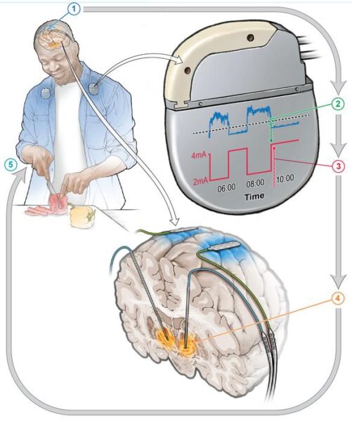 Implanted device responds to changes in brain signals, adjusting the amount of stimulation throughout the day, allowing individuals to go about their daily activities.