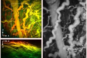 Disease captured by UCL hand-held 3D photoacoustic scanner.