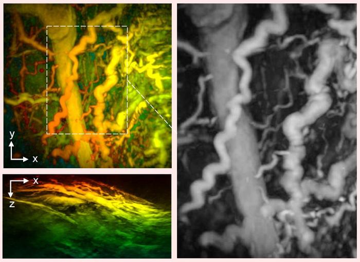 Disease captured by UCL hand-held 3D photoacoustic scanner.