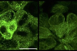 Cells containing tau aggregates (green) before (left) and 13 hours after treatment with RING-nanobody (right)