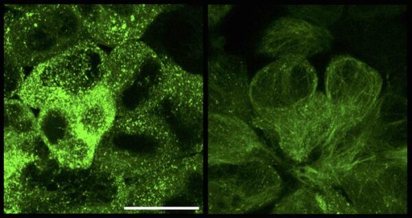 Therapy targets and destroys tau tangles in Alzheimer’s treatment