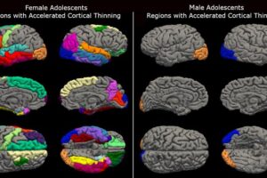 New research from the University of Washington’s Institute for Learning & Brain Sciences, or I-LABS, found the COVID-19 pandemic lockdowns resulted in unusually accelerated brain maturation in adolescents. This maturation was more pronounced in females, as seen on the left.