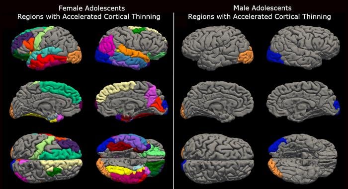 New research from the University of Washington’s Institute for Learning & Brain Sciences, or I-LABS, found the COVID-19 pandemic lockdowns resulted in unusually accelerated brain maturation in adolescents. This maturation was more pronounced in females, as seen on the left.