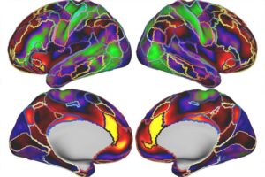 The image displays four views of a person's brain, highlighting the boundaries between different functional brain networks, each represented by different colored lines, as mapped using functional MRI. This map is overlaid on a salience network connectivity heat map, where warmer colors indicate stronger connectivity within the salience network. Researchers discovered that a larger salience network may be associated with an increased risk of depression. Credit: Lynch/Liston Labs.