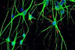 Researchers have formed a consortium called SSPsyGene with the shared objective of studying the genetic causes of neurodevelopmental and psychiatric disorders (NPD). Their focus is on 250 high-risk genes that may contribute to these conditions. In the project's initial phase, they tested 23 of these risk genes. The stem cell lines they generated from this research will be shared globally to aid other scientists in studying how these genes contribute to NPD.