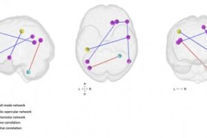 Restless sleep correlates with lower connectivity between the default mode network nodes, and default mode network and somatomotor network nodes. The default mode network is a group of brain regions that are active when we are at rest, not focusing on any specific task. The somatomotor network involves brain regions that are responsible for controlling movement and processing sensations from the body, such as touch and physical feedback.