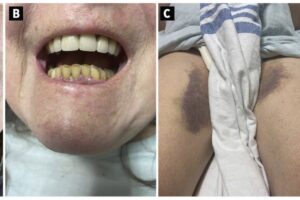 A 65-year-old woman with hypovitaminosis C (scurvy), showing gingival ecchymosis and hypertrophy without (A, B) dental loosening or missing teeth, (C) large ecchymosis of the medial thighs, and (D) perifollicular petechia of the lower extremities.