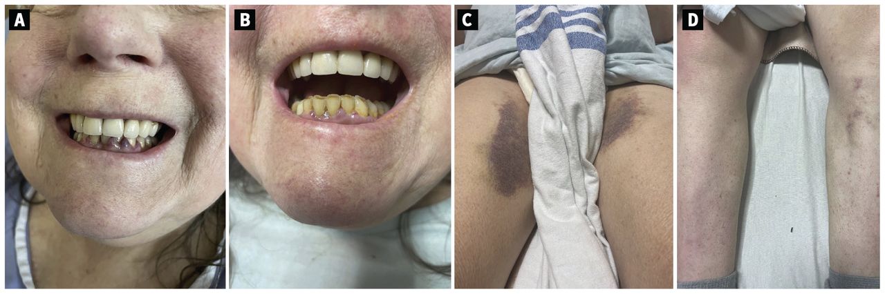 A 65-year-old woman with hypovitaminosis C (scurvy), showing gingival ecchymosis and hypertrophy without (A, B) dental loosening or missing teeth, (C) large ecchymosis of the medial thighs, and (D) perifollicular petechia of the lower extremities.