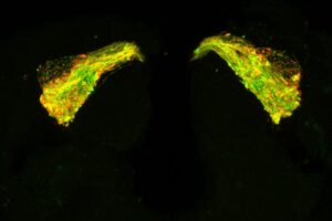 The brain of a 7-day-old fruit fly with Tau expressed in a neuronal circuit used by the fly in olfactory memory. The green outlines the neurons, which are starting to swell and degenerate due to the Tau protein. The red shows where Tau is building up in clusters along the neurons, starting to form the clumps that eventually become rope-like fibrils.