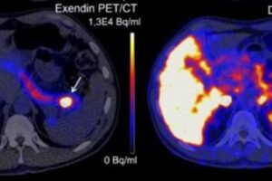 This is a cross-sectional view of the torso. The gray areas show the anatomy based on the CT scan, while the colored sections represent the radioactive signal measured by the PET scan. On the left is the new scan using radioactive Exendin: the entire pancreas is visible, but the location of the benign tumor is very clear. On the right is the current scan.