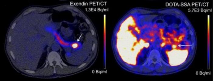  the entire pancreas is visible, but the location of the benign tumor is very clear. On the right is the current scan.