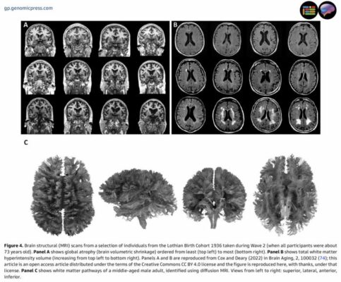 25-Year Study Reveals Childhood Intelligence Shapes Brain Health in Old Age