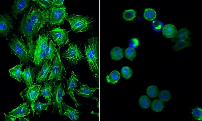  destabilised cervical cancer cells after gold compound treatment show structural integrity compromised while the nuclei in blue are breaking apart, indicating cell death. 