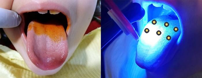 In the antimicrobial photodynamic therapy session, annatto photosensitizer was sprayed on to the tongue at a concentration of 20%