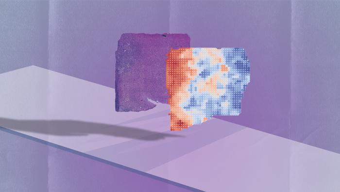 A new AI program, SEQUOIA, can analyze a microscopy image from a tumor biopsy (left, purple) and rapidly determine what genes are likely turned on and off in the cells it contains (gene expression shown in shades of red and blue on right).