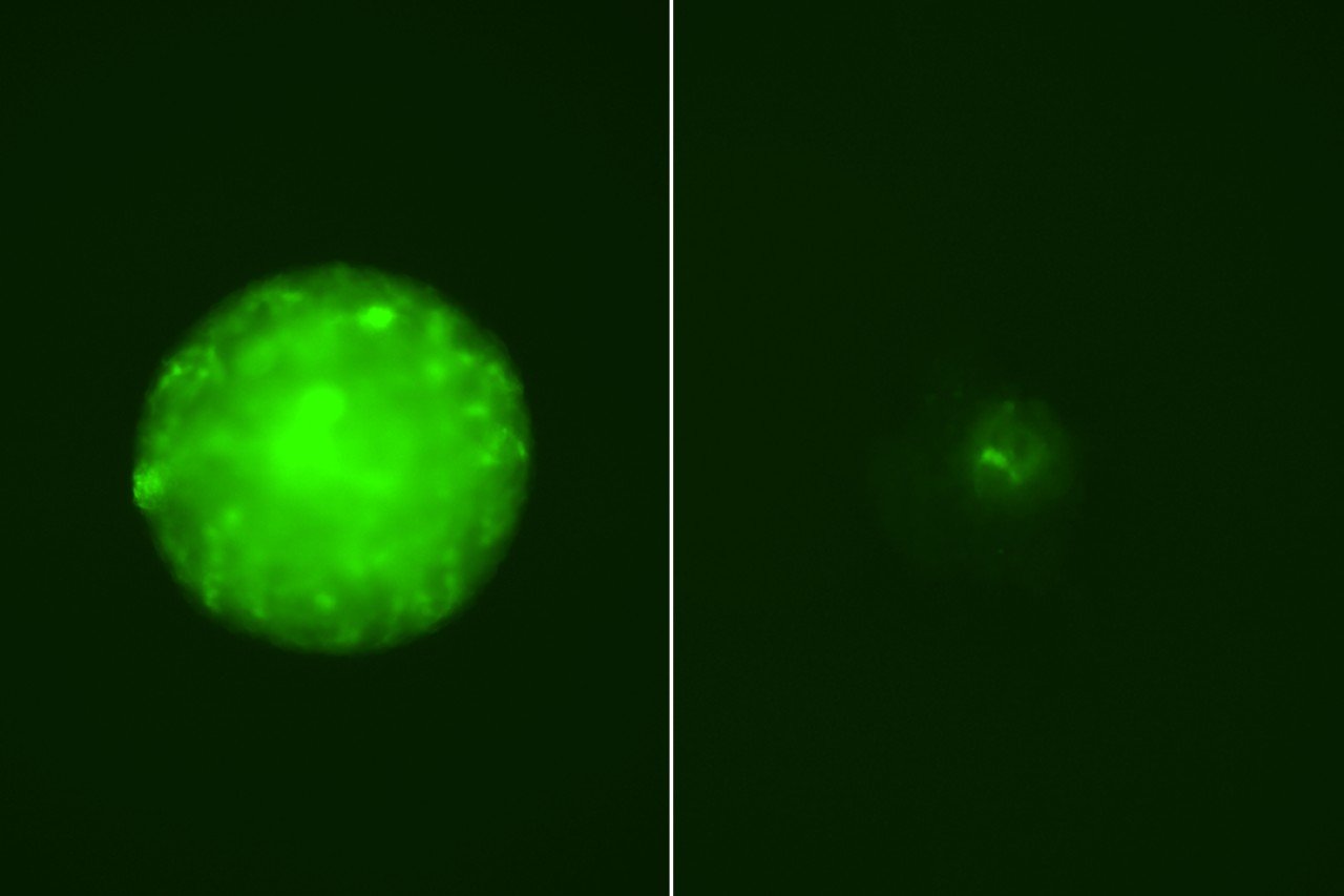 Untreated patient-derived glioblastoma cells (left) compared to glioblastoma cells treated with a combination of radiation and ABBV-155 (right). Green fluorescence marks viable cells, illustrating how the therapy induces cell death. Courtesy of the Nathanson Laboratory.