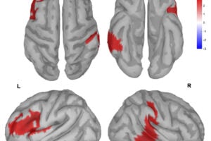 Source analysis of the delta EEG activity associated with the FF condition. Significant differences (P < 0.01, cluster-based correction) in T1/T0 delta ratios between FF and NF. Specifically, difference peaks were found in the left IFG (−36, 16, 28) and in the right middle temporal lobe (70, −30, −2).